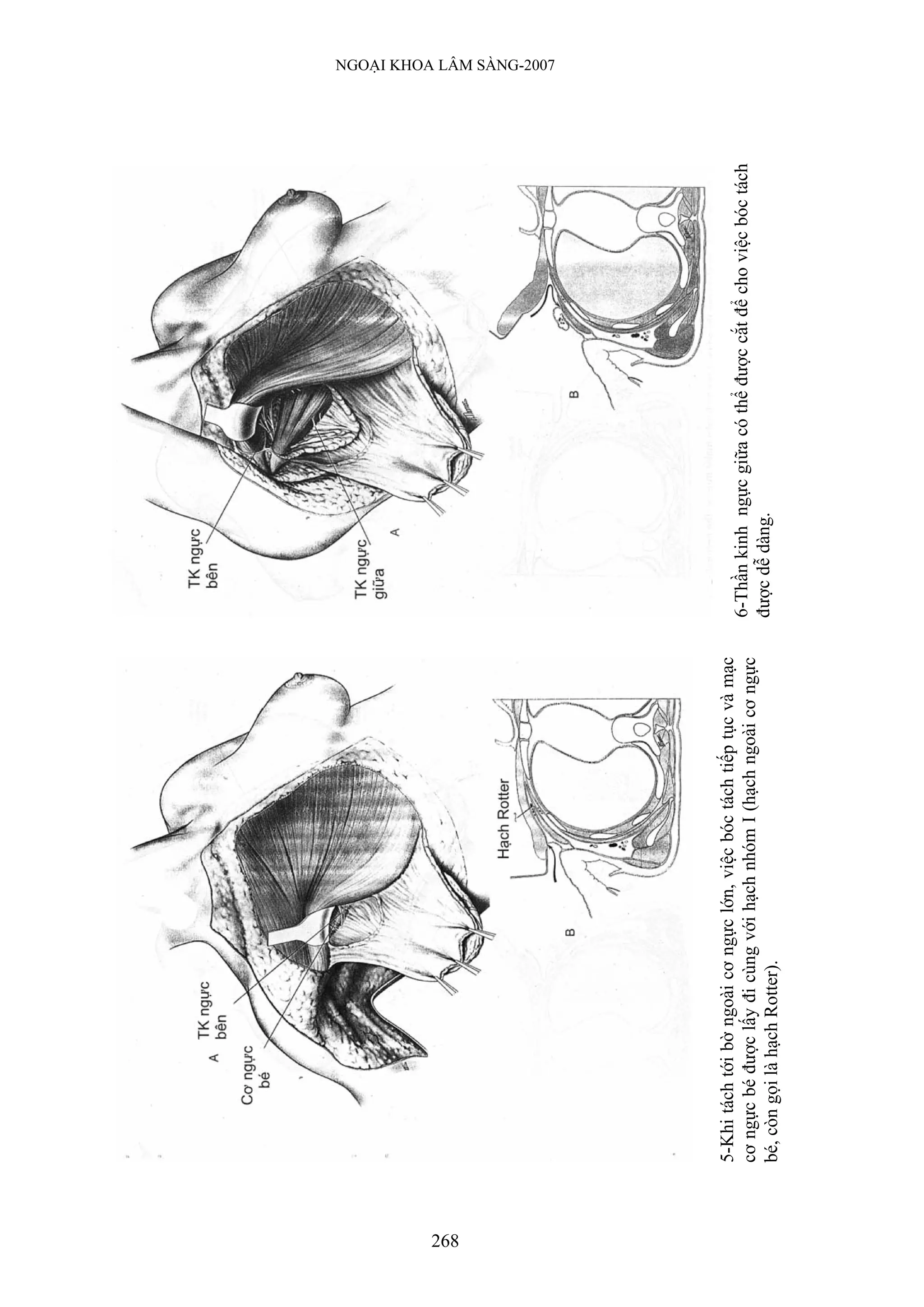 268
                                                                                                                                        NGOẠI KHOA LÂM SÀNG-2007




      5-Khi tách tới bờ ngoài cơ ngực lớn, việc bóc tách tiếp tục và mạc
      cơ ngực bé được lấy đi cùng với hạch nhóm I (hạch ngoài cơ ngực      6-Thần kinh ngực giữa có thể được cắt để cho việc bóc tách
      bé, còn gọi là hạch Rotter).                                         được dễ dàng.
 