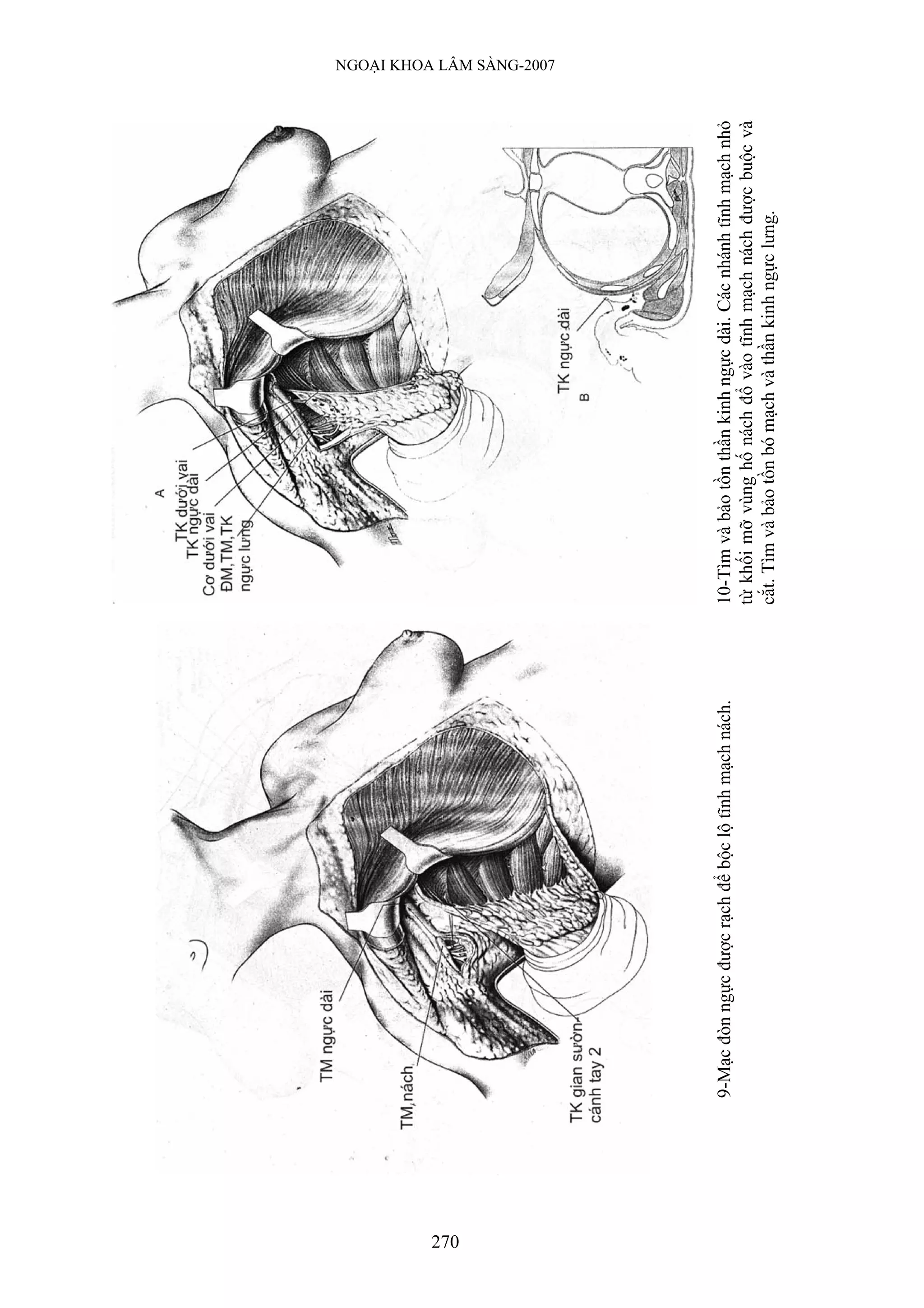 270
                                                                                                                           NGOẠI KHOA LÂM SÀNG-2007




      9-Mạc đòn ngực được rạch để bộc lộ tĩnh mạch nách.   10-Tìm và bảo tồn thần kinh ngực dài. Các nhánh tĩnh mạch nhỏ
                                                           từ khối mỡ vùng hố nách đổ vào tĩnh mạch nách được buộc và
                                                           cắt. Tìm và bảo tồn bó mạch và thần kinh ngực lưng.
 