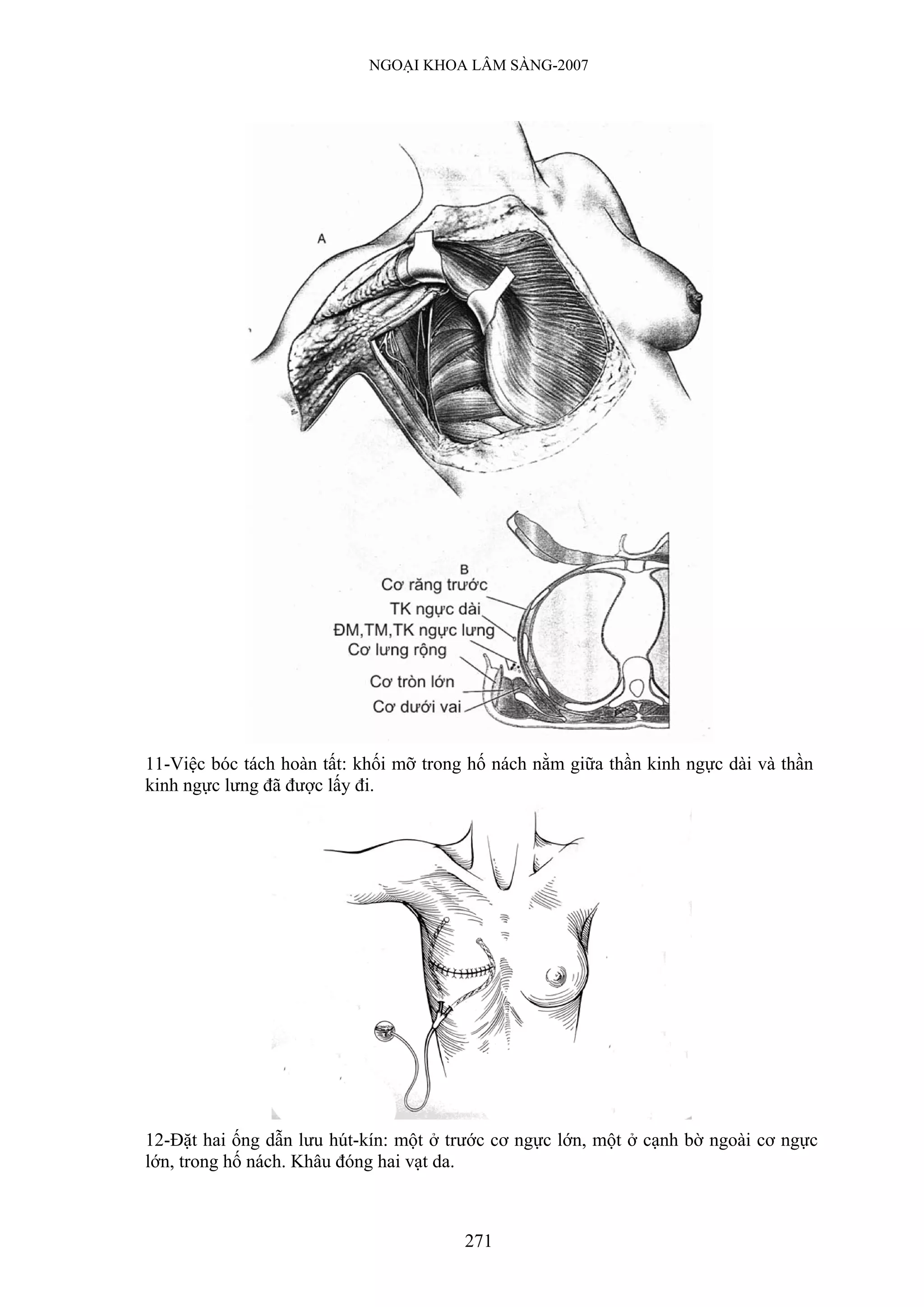 NGOẠI KHOA LÂM SÀNG-2007




11-Việc bóc tách hoàn tất: khối mỡ trong hố nách nằm giữa thần kinh ngực dài và thần
kinh ngực lưng đã được lấy đi.




12-Đặt hai ống dẫn lưu hút-kín: một ở trước cơ ngực lớn, một ở cạnh bờ ngoài cơ ngực
lớn, trong hố nách. Khâu đóng hai vạt da.



                                        271
 