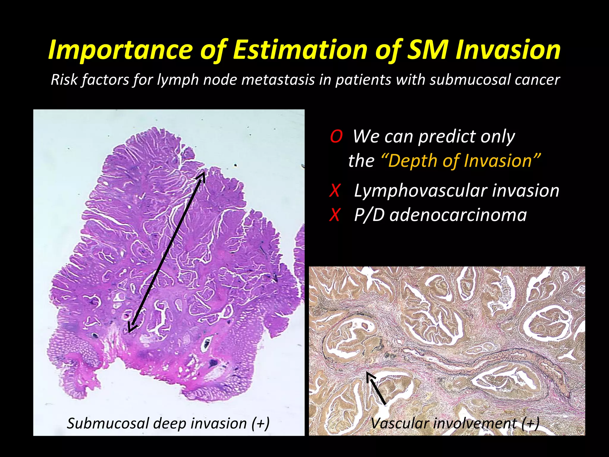 Endoscopy In Gastrointestinal Oncology Slide 18 T Matsuda 