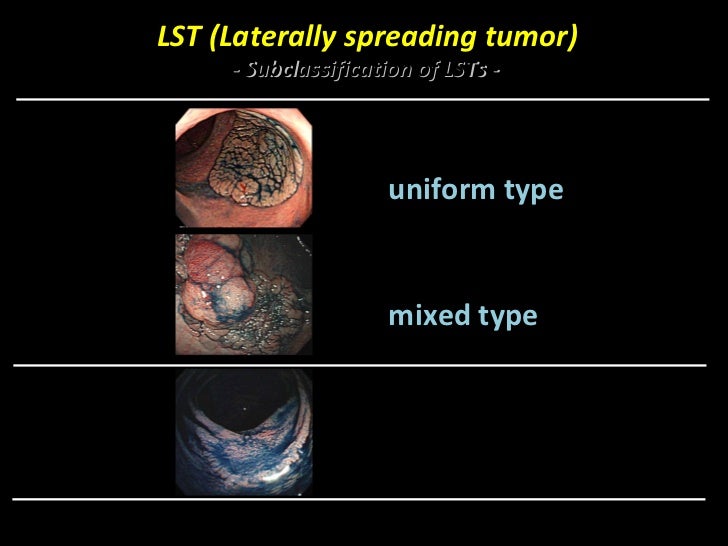 Endoscopy in Gastrointestinal Oncology Slide 18 T. Matsuda Colo…