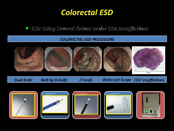 Endoscopy in Gastrointestinal Oncology Slide 18 T. Matsuda Colo…