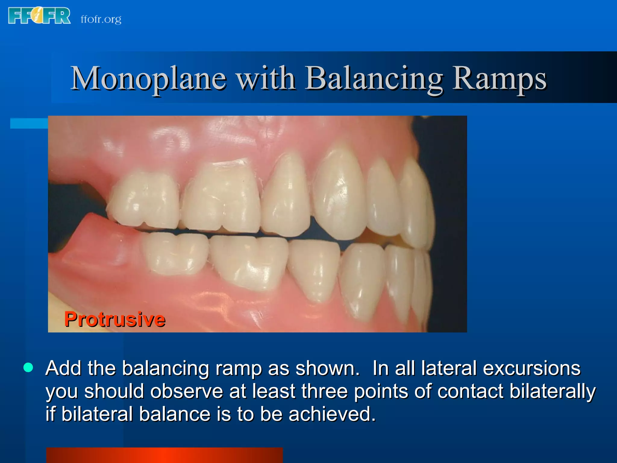 18.occlusal schemes monoplane with balancing ramps | PPT