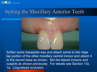 Maxillary Ramps 18.occlusal schemes monoplane with balancing ramps | PPT