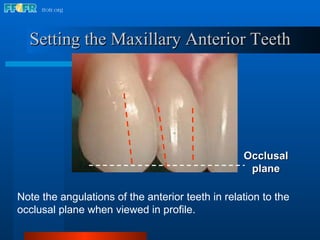 18.occlusal schemes monoplane with balancing ramps | PPT