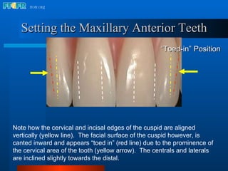18.occlusal schemes monoplane with balancing ramps | PPT