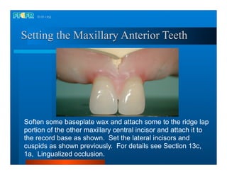 18.occlusal schemes monoplane with balancing ramps | PDF