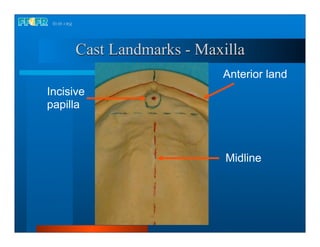 18.occlusal schemes monoplane with balancing ramps | PDF