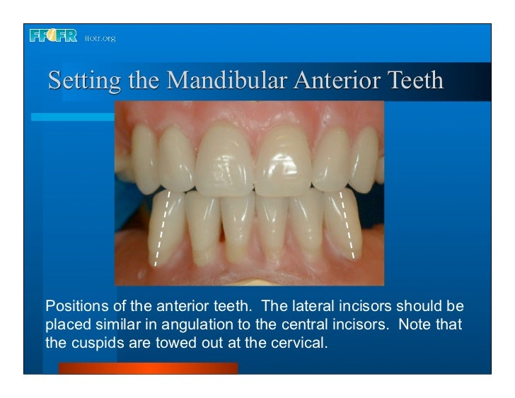 18.occlusal schemes monoplane with balancing ramps