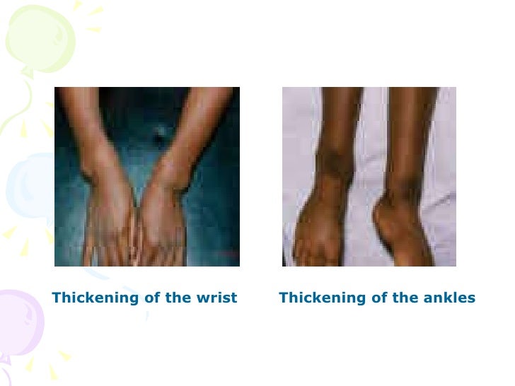18 Rickets Of Vitamin D Deficiency,Tetany Of Vitamin D Deficiency