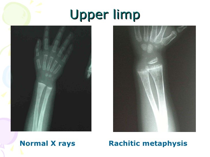 18 Rickets Of Vitamin D Deficiency,Tetany Of Vitamin D Deficiency