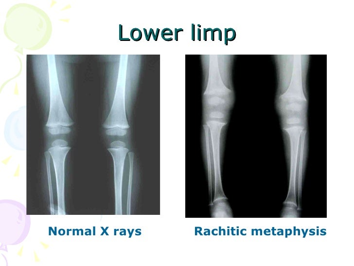 18 Rickets Of Vitamin D Deficiency,Tetany Of Vitamin D ...