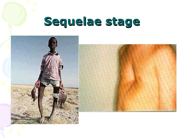 18 Rickets Of Vitamin D Deficiency,Tetany Of Vitamin D Deficiency