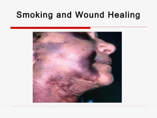 Smoking and Wound Healing 