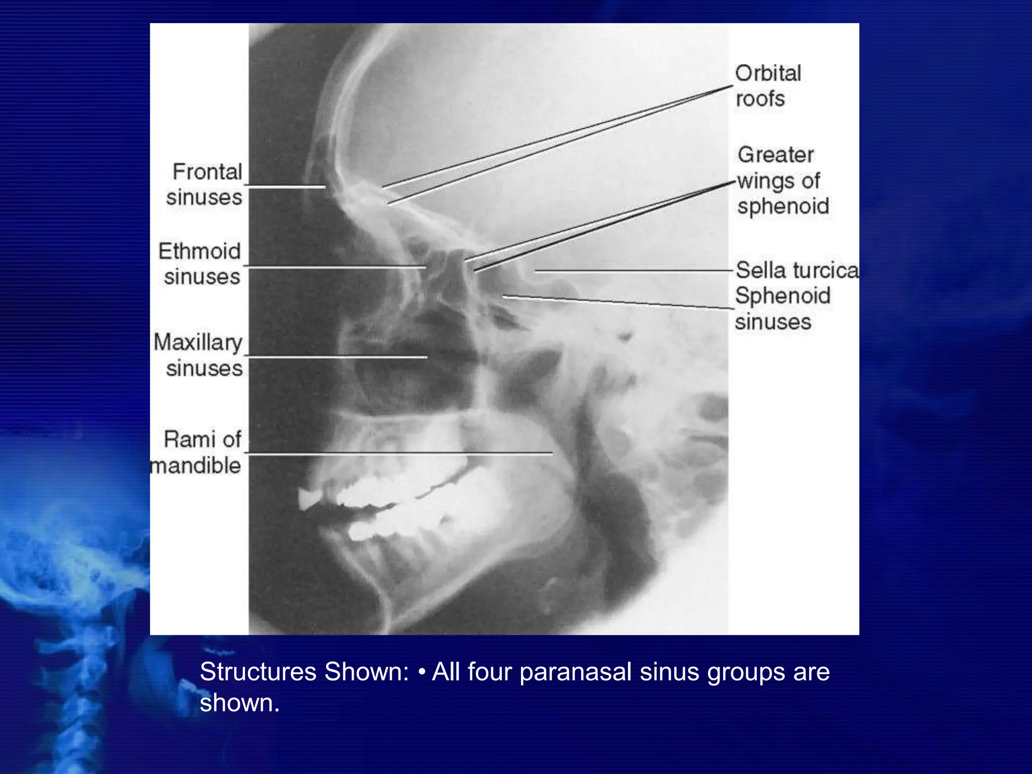 Structures Shown: • All four paranasal sinus groups are
shown.
 