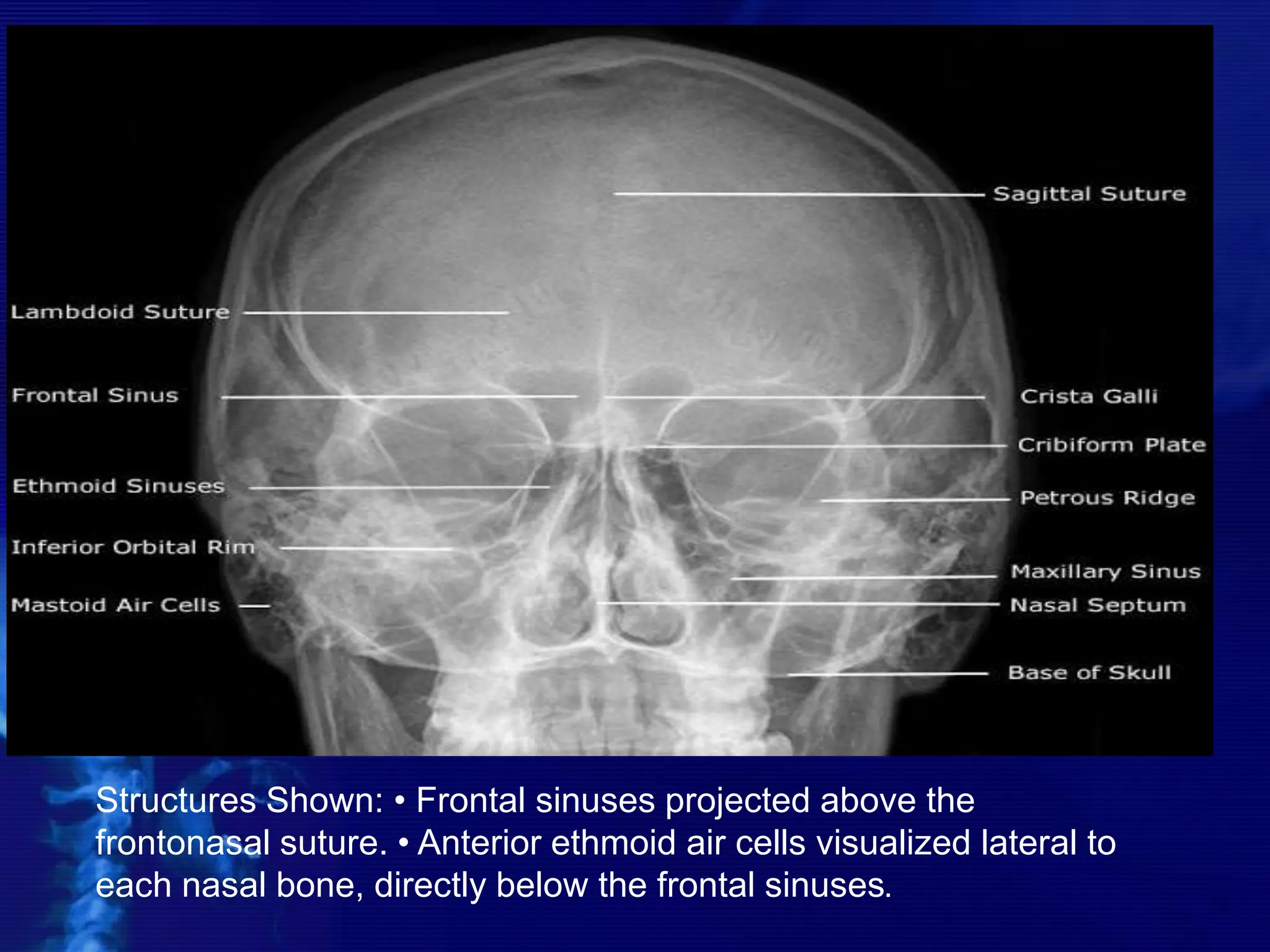 Structures Shown: • Frontal sinuses projected above the
frontonasal suture. • Anterior ethmoid air cells visualized lateral to
each nasal bone, directly below the frontal sinuses.
 
