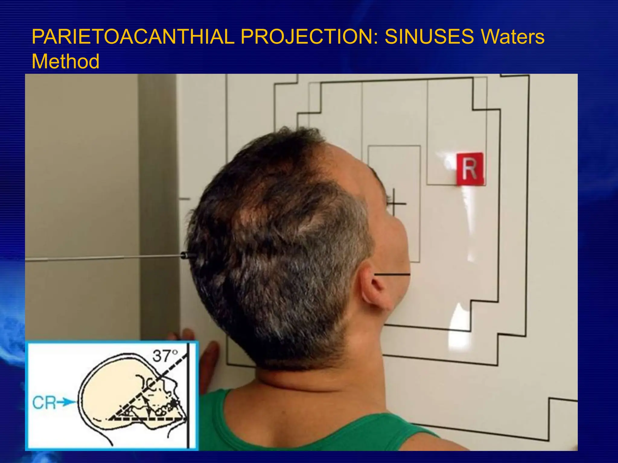 PARIETOACANTHIAL PROJECTION: SINUSES Waters
Method
 