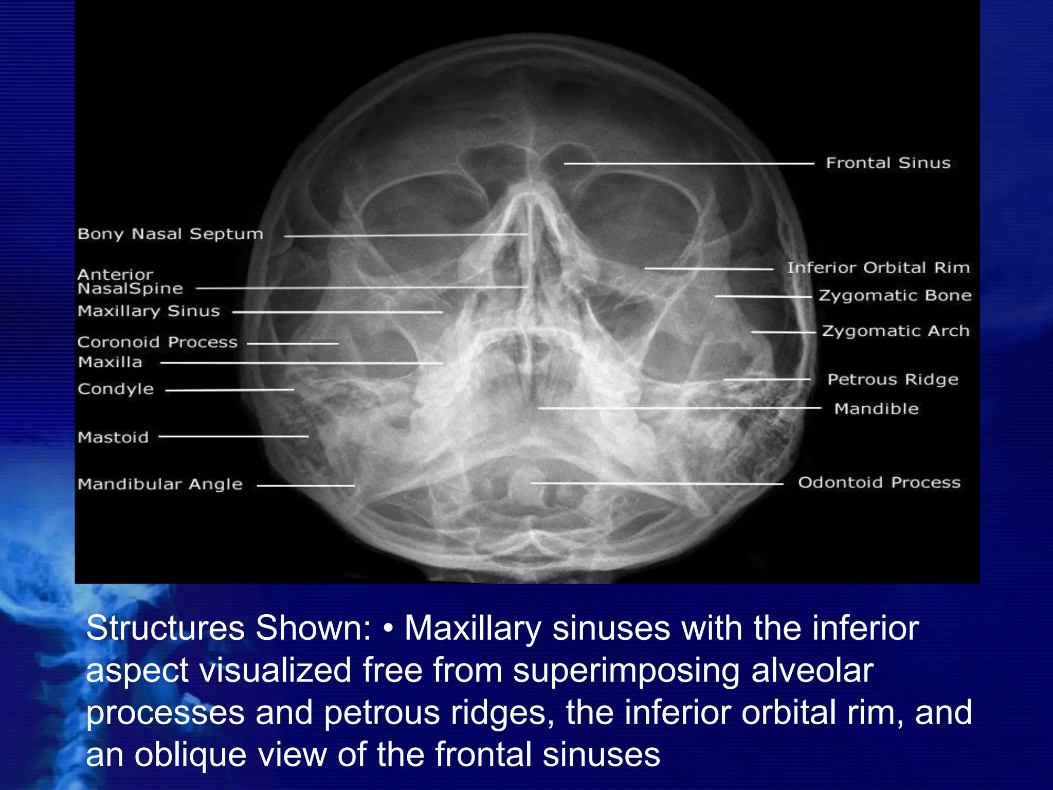 Structures Shown: • Maxillary sinuses with the inferior
aspect visualized free from superimposing alveolar
processes and petrous ridges, the inferior orbital rim, and
an oblique view of the frontal sinuses
 