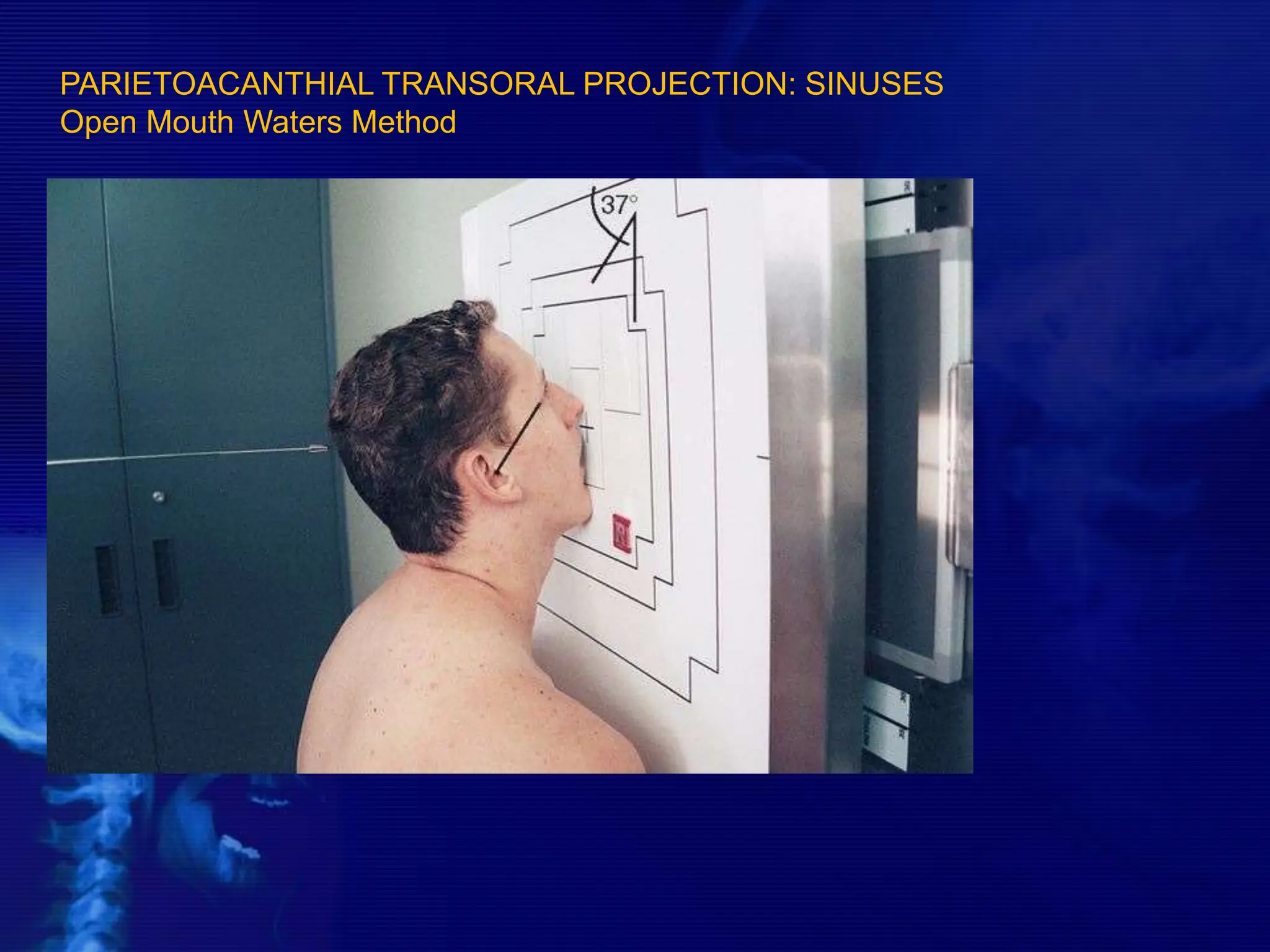 PARIETOACANTHIAL TRANSORAL PROJECTION: SINUSES
Open Mouth Waters Method
 