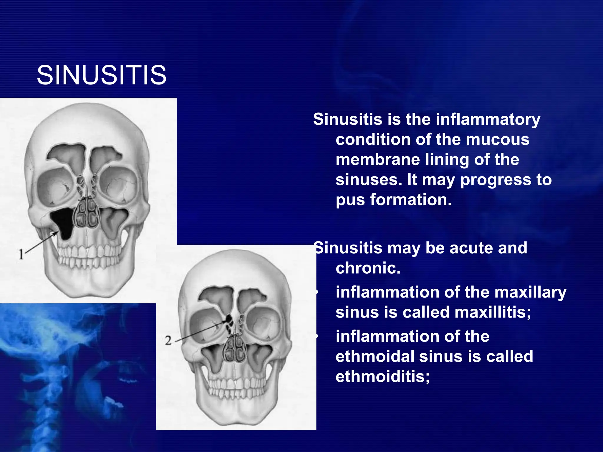 SINUSITIS
Sinusitis is the inflammatory
condition of the mucous
membrane lining of the
sinuses. It may progress to
pus formation.
Sinusitis may be acute and
chronic.
• inflammation of the maxillary
sinus is called maxillitis;
• inflammation of the
ethmoidal sinus is called
ethmoiditis;
 