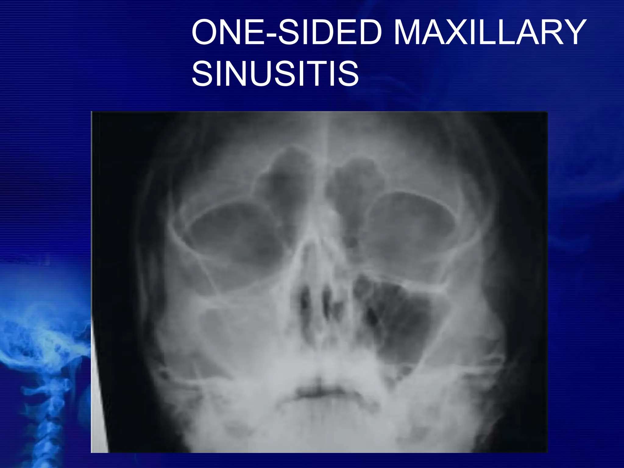 ONE-SIDED MAXILLARY
SINUSITIS
 