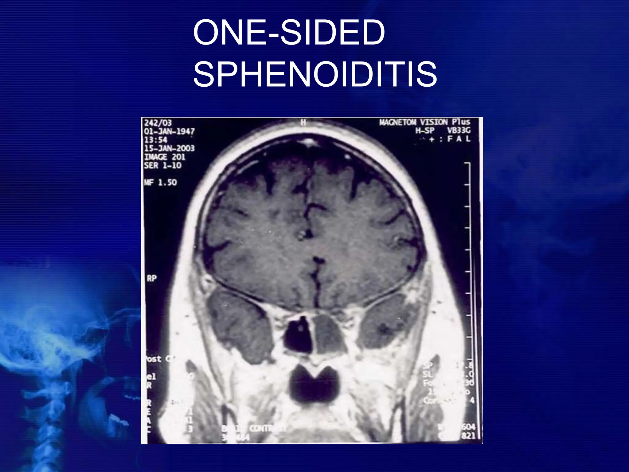 ONE-SIDED
SPHENOIDITIS
 