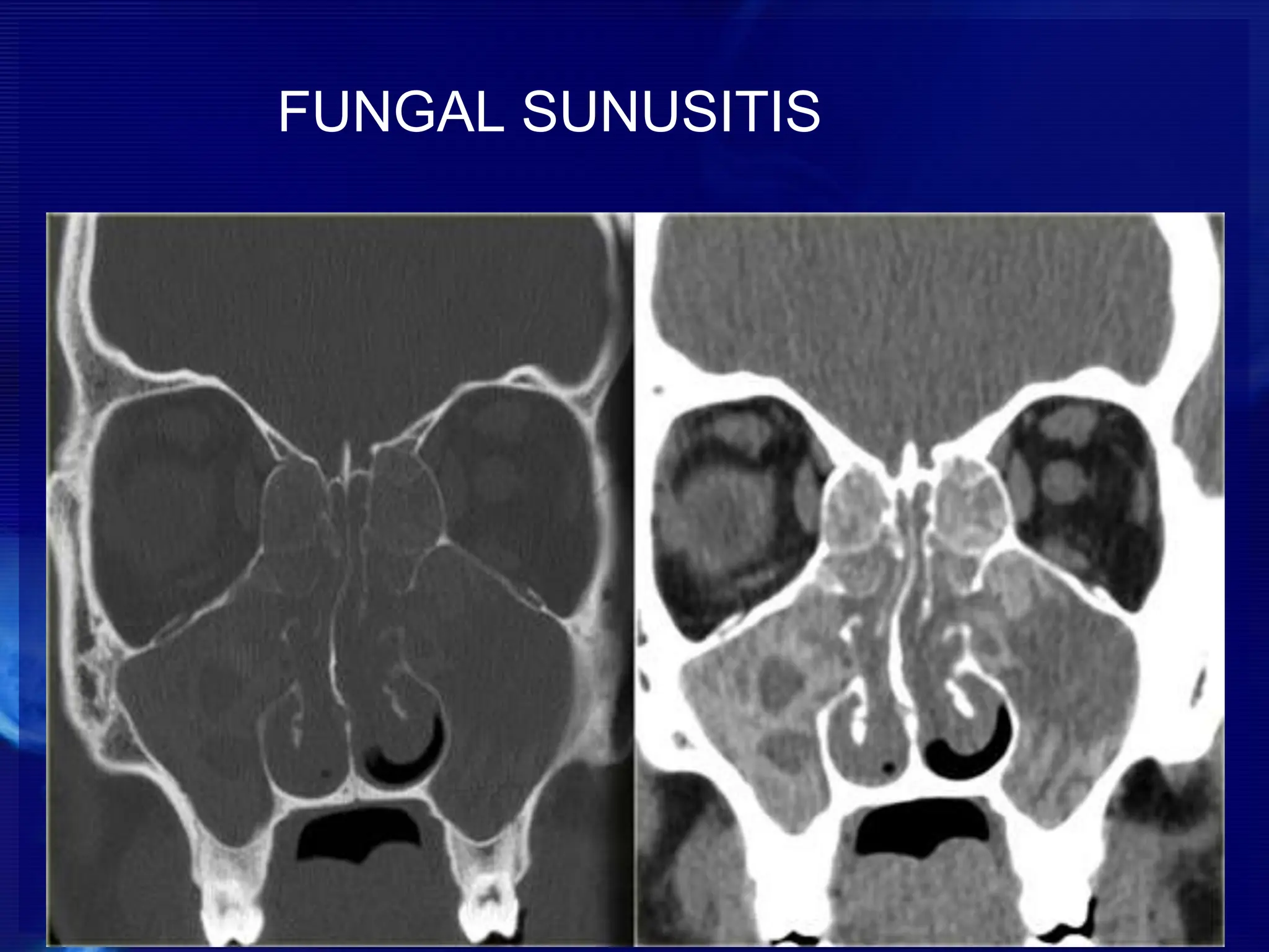 FUNGAL SUNUSITIS
 