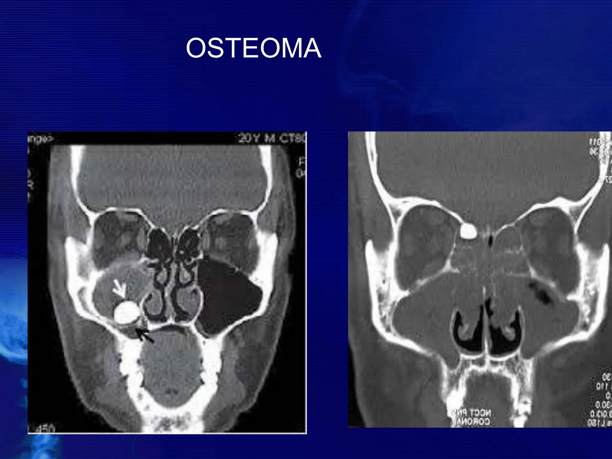 OSTEOMA
 