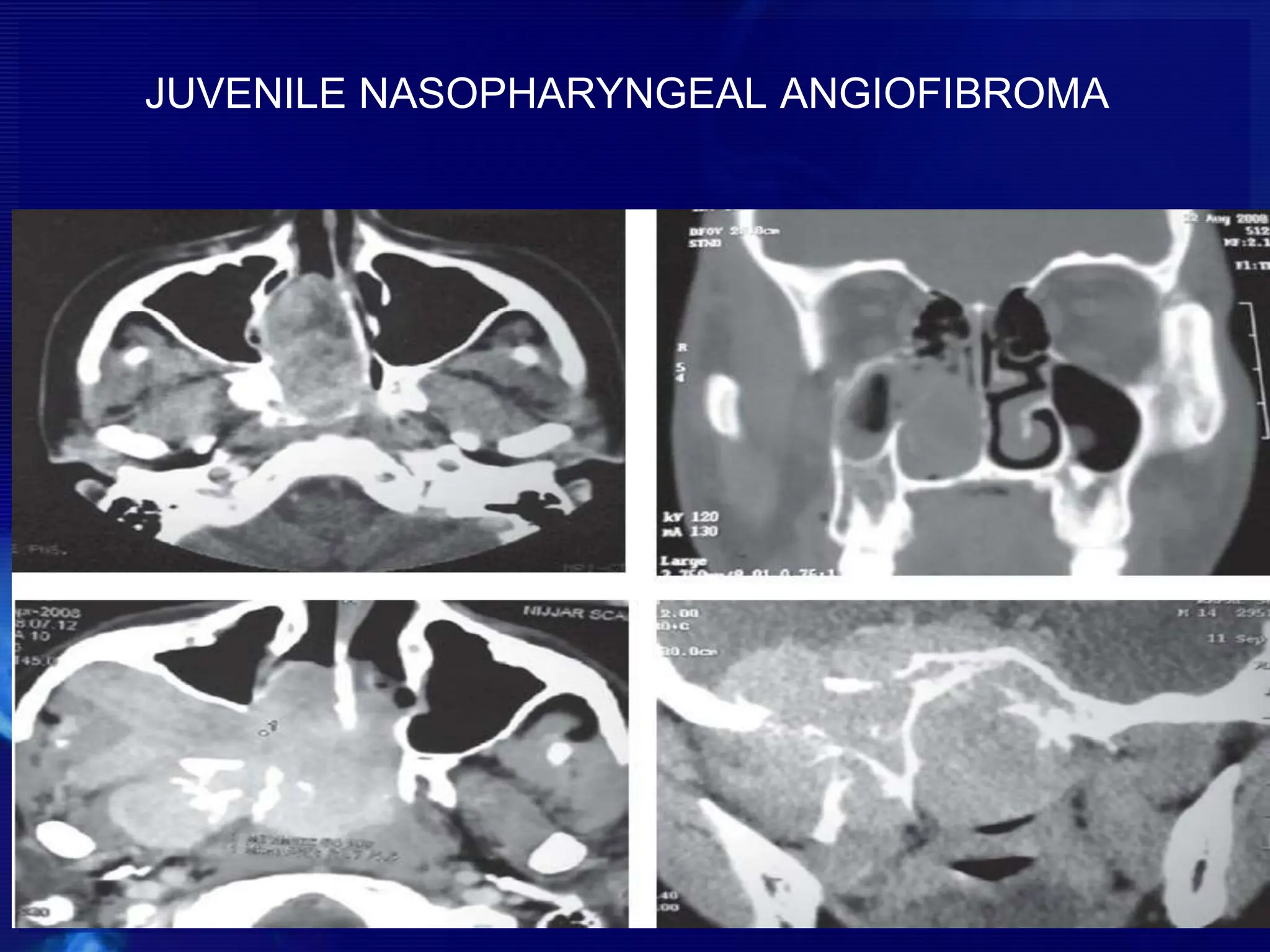 JUVENILE NASOPHARYNGEAL ANGIOFIBROMA
 