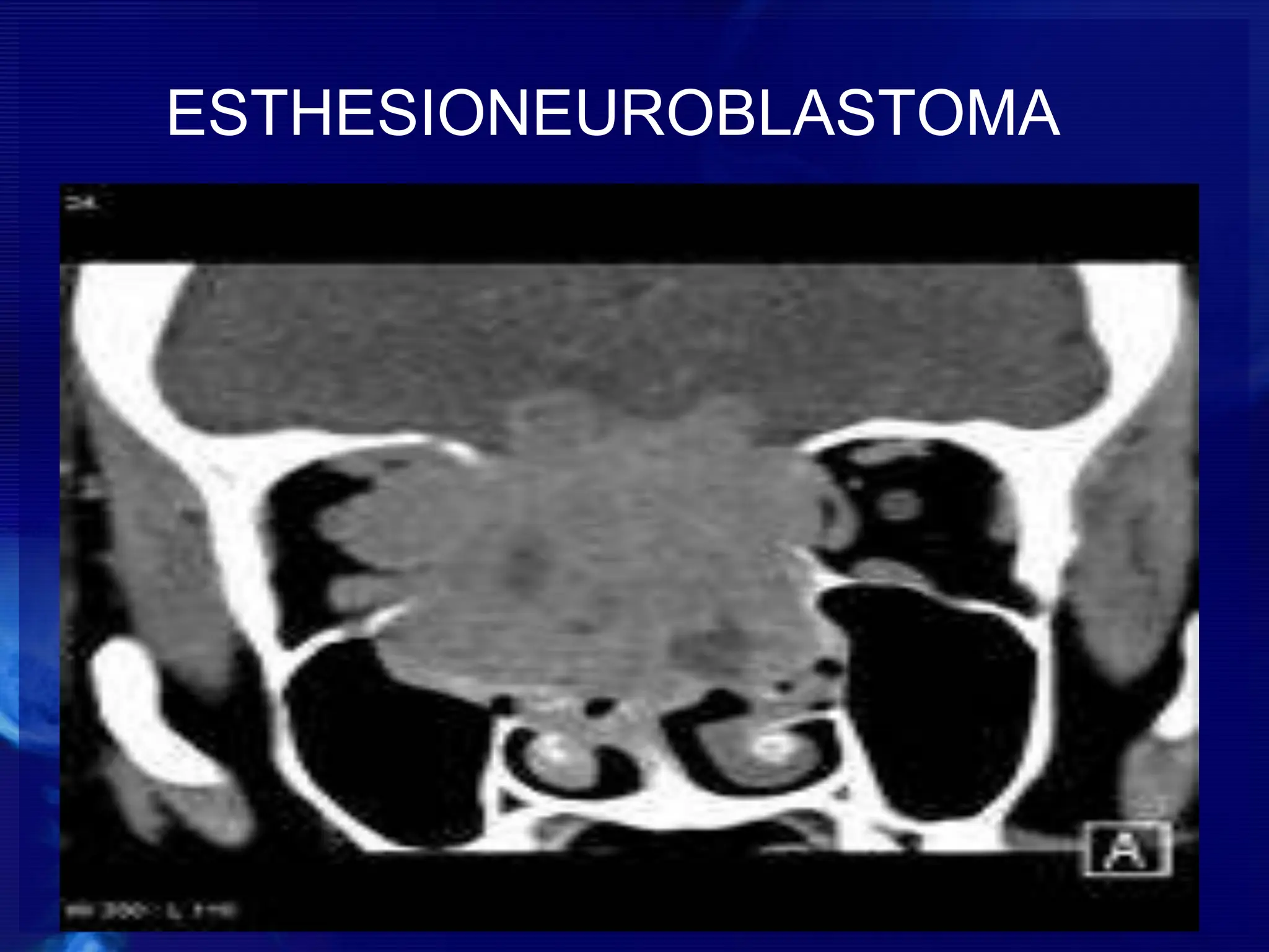 ESTHESIONEUROBLASTOMA
-drdhiru456@gmail.com
 