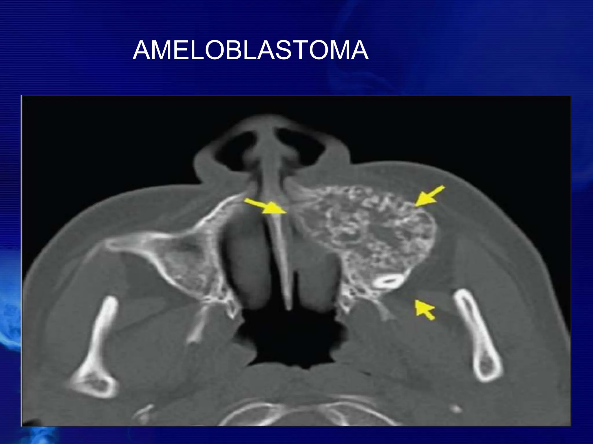 AMELOBLASTOMA
 