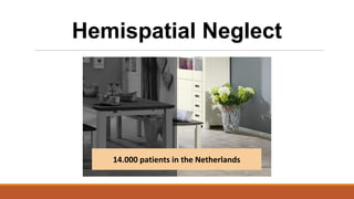 14.000 patients in the Netherlands
Hemispatial Neglect
 