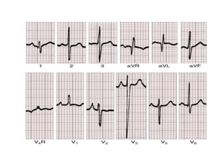 CONGENITAL CORONARY ANOMALIES AND VARIANTS, ALCAPA | PPTX