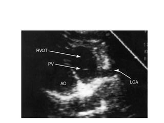 CONGENITAL CORONARY ANOMALIES AND VARIANTS, ALCAPA | PPTX