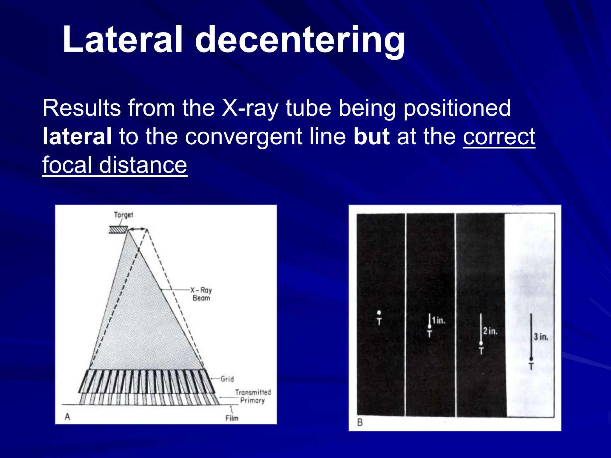 Lateral decentering
Results from the X-ray tube being positioned
lateral to the convergent line but at the correct
focal distance
 
