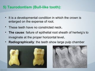 Bull Tooth developmental anomalies of teeth | PPT
