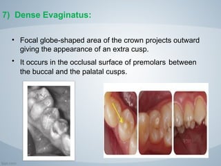 developmental anomalies of teeth | PPT