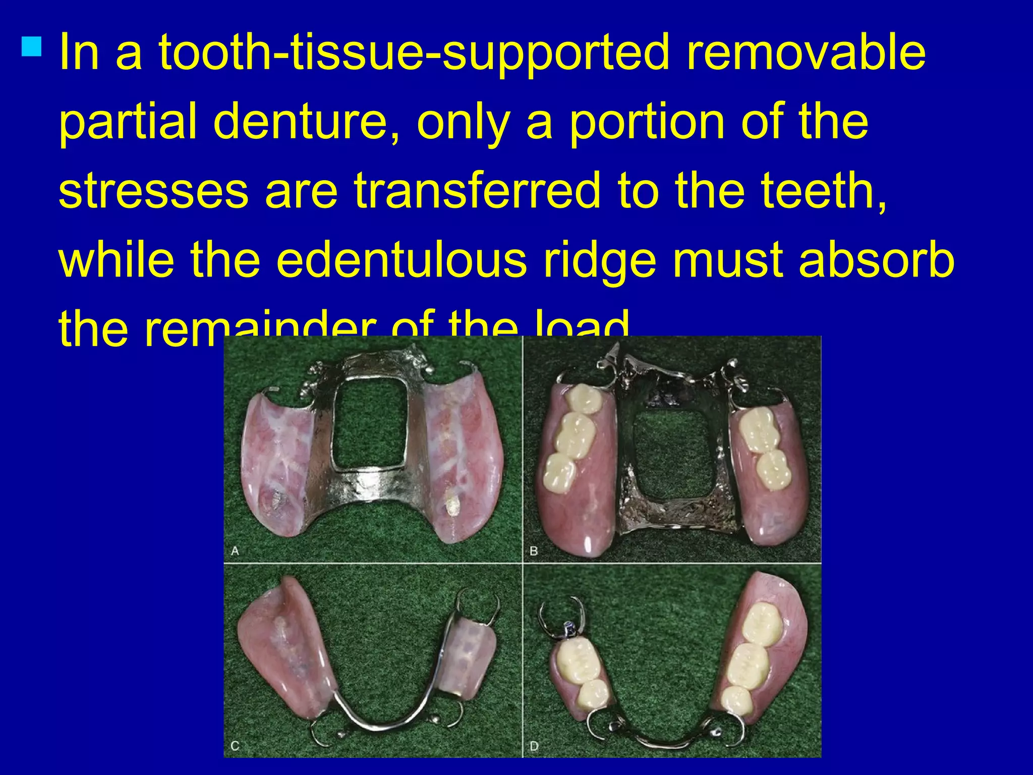  In a tooth-tissue-supported removable
partial denture, only a portion of the
stresses are transferred to the teeth,
while the edentulous ridge must absorb
the remainder of the load.
 