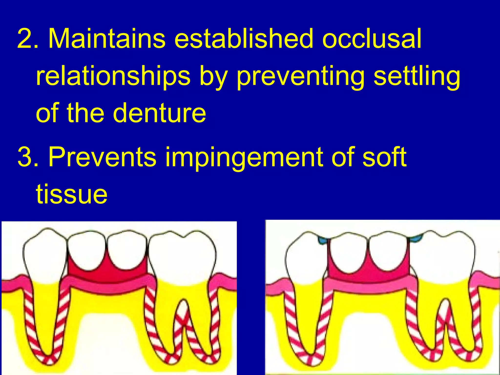 2. Maintains established occlusal
relationships by preventing settling
of the denture
3. Prevents impingement of soft
tissue
 