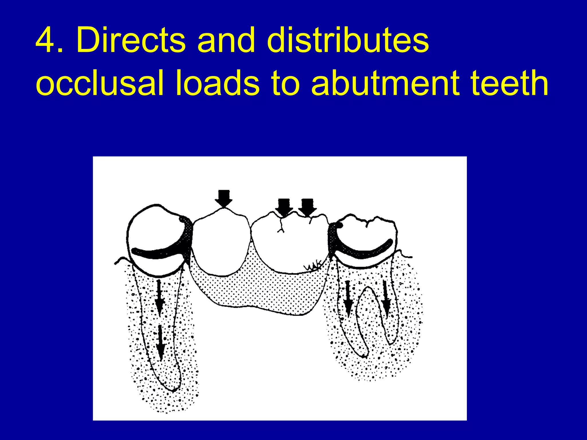 4. Directs and distributes
occlusal loads to abutment teeth
 