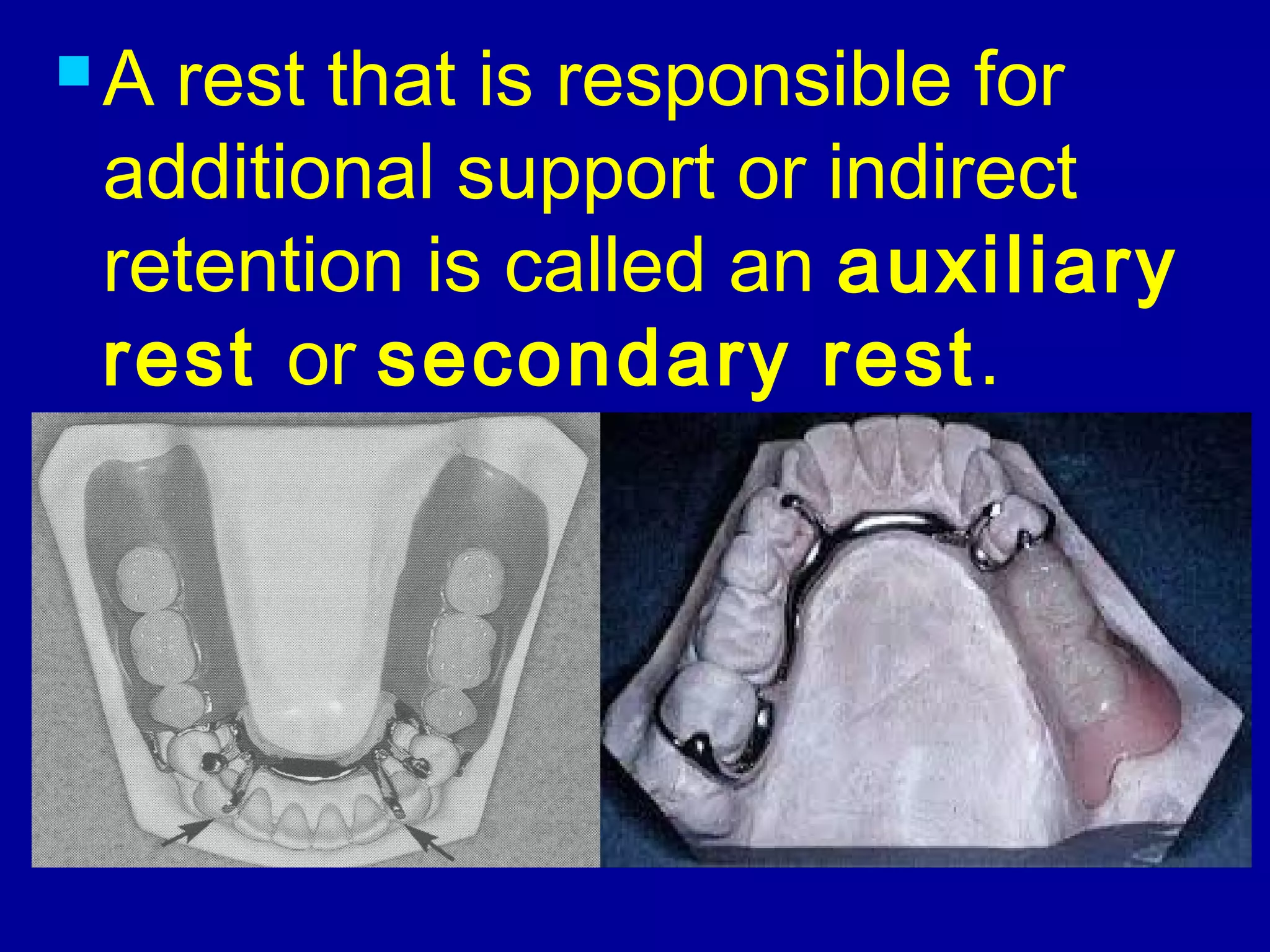  A rest that is responsible for
additional support or indirect
retention is called an auxiliary
rest or secondary rest.
 