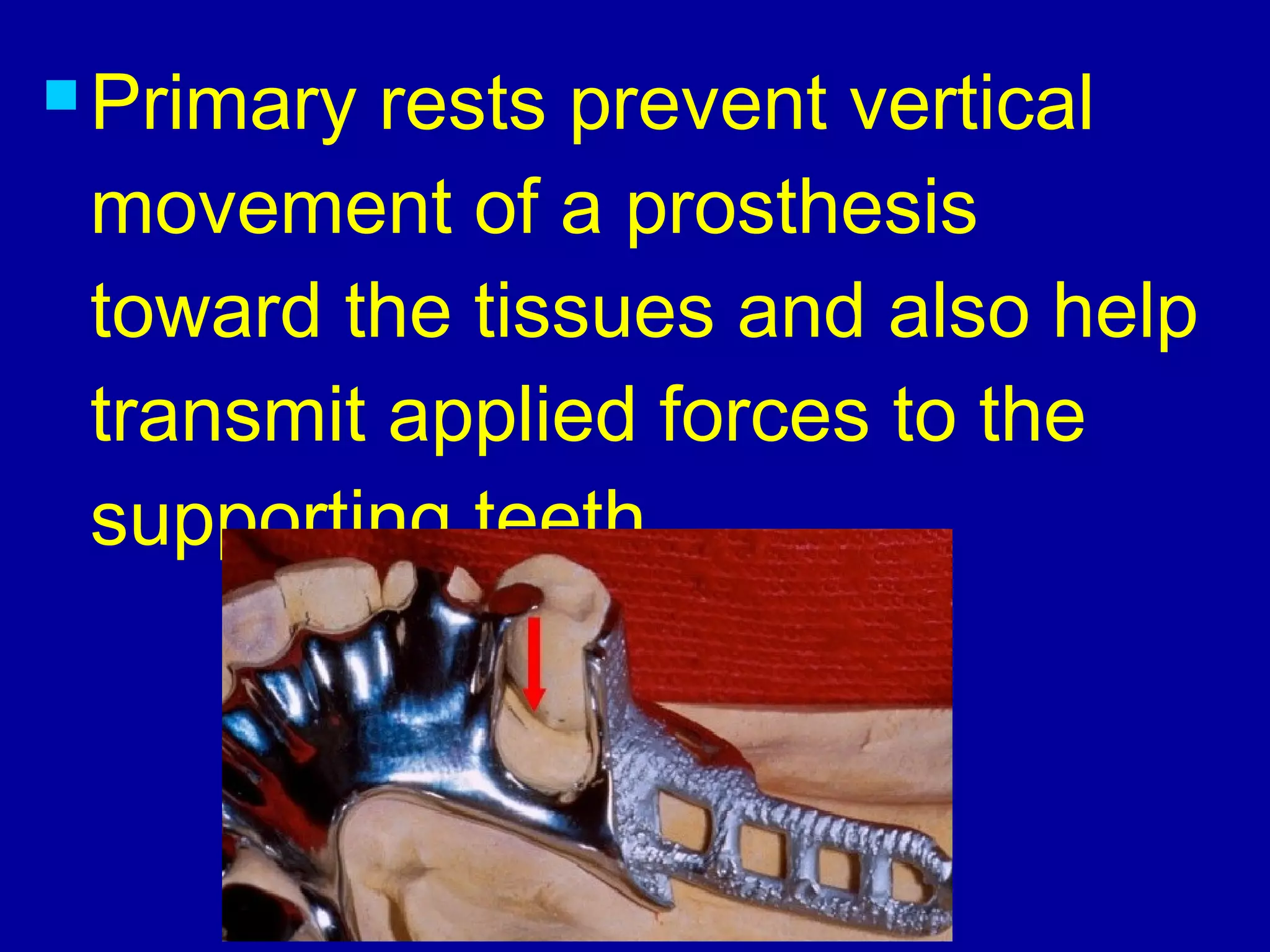  Primary rests prevent vertical
movement of a prosthesis
toward the tissues and also help
transmit applied forces to the
supporting teeth.
 