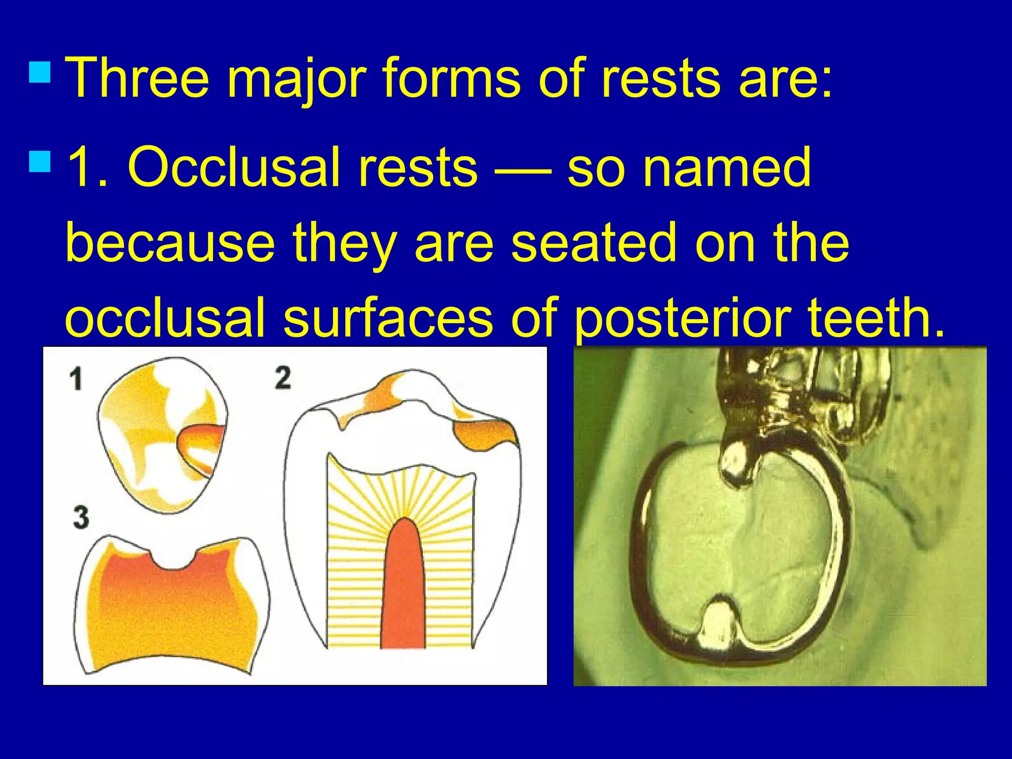  Three major forms of rests are:
 1. Occlusal rests — so named
because they are seated on the
occlusal surfaces of posterior teeth.
 