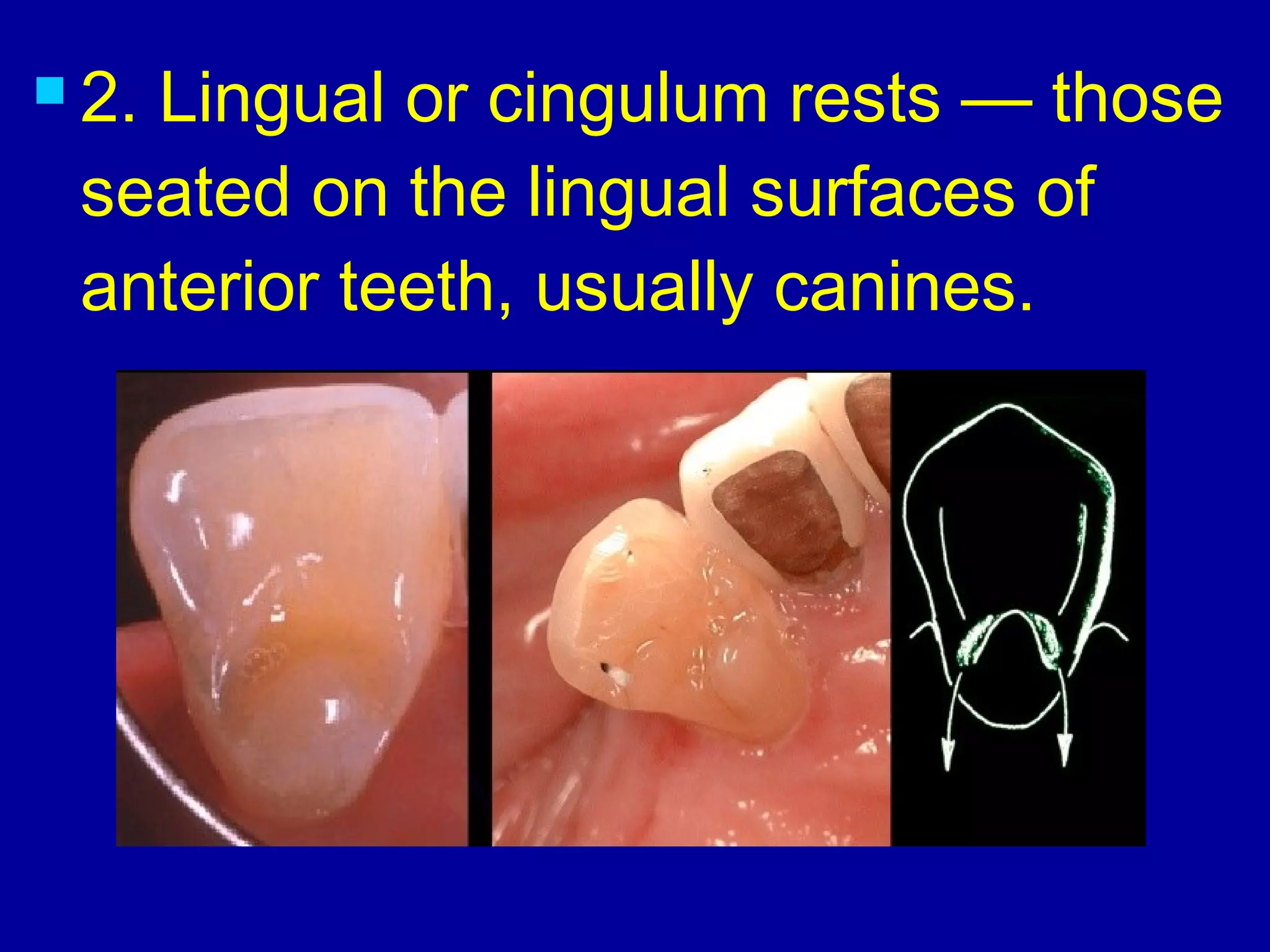  2. Lingual or cingulum rests — those
seated on the lingual surfaces of
anterior teeth, usually canines.
 