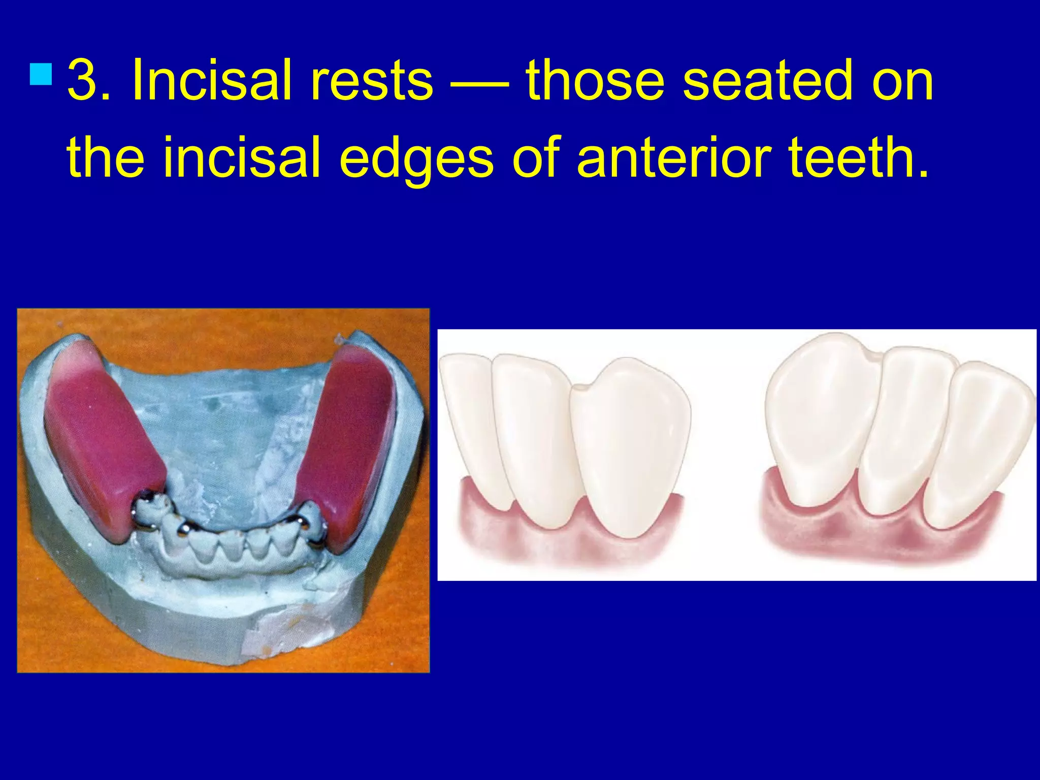  3. Incisal rests — those seated on
the incisal edges of anterior teeth.
 