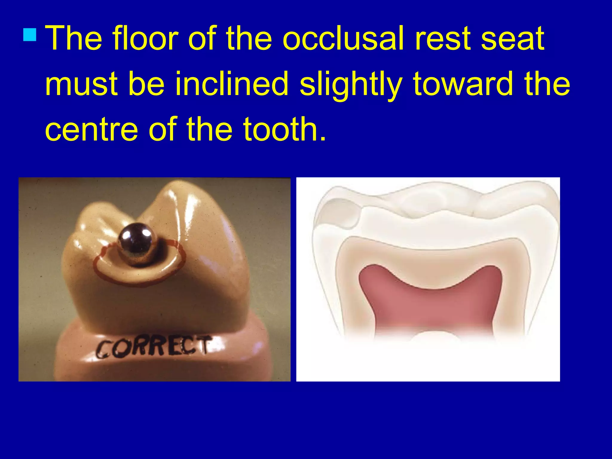  The floor of the occlusal rest seat
must be inclined slightly toward the
centre of the tooth.
 