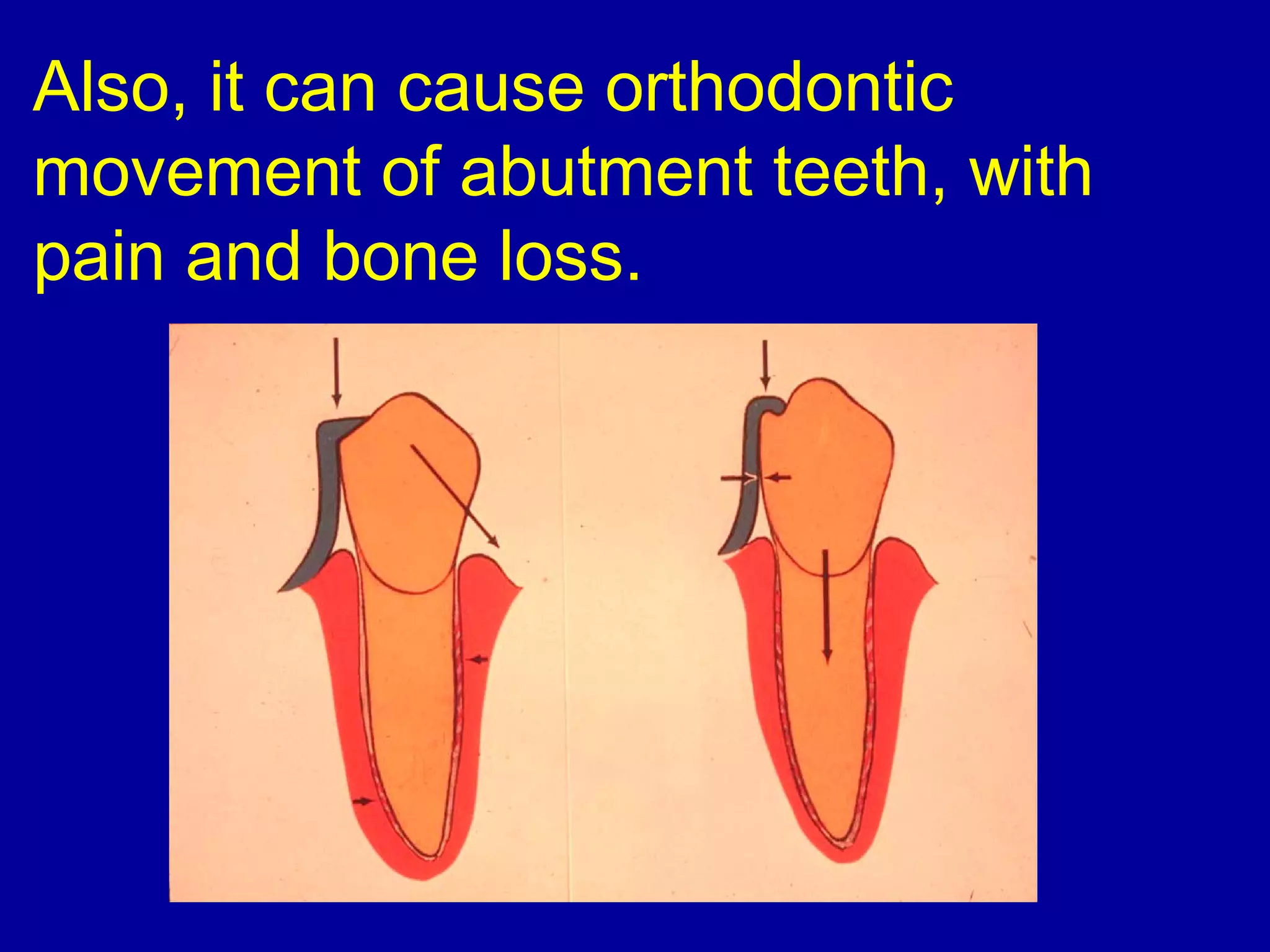Also, it can cause orthodontic
movement of abutment teeth, with
pain and bone loss.
 