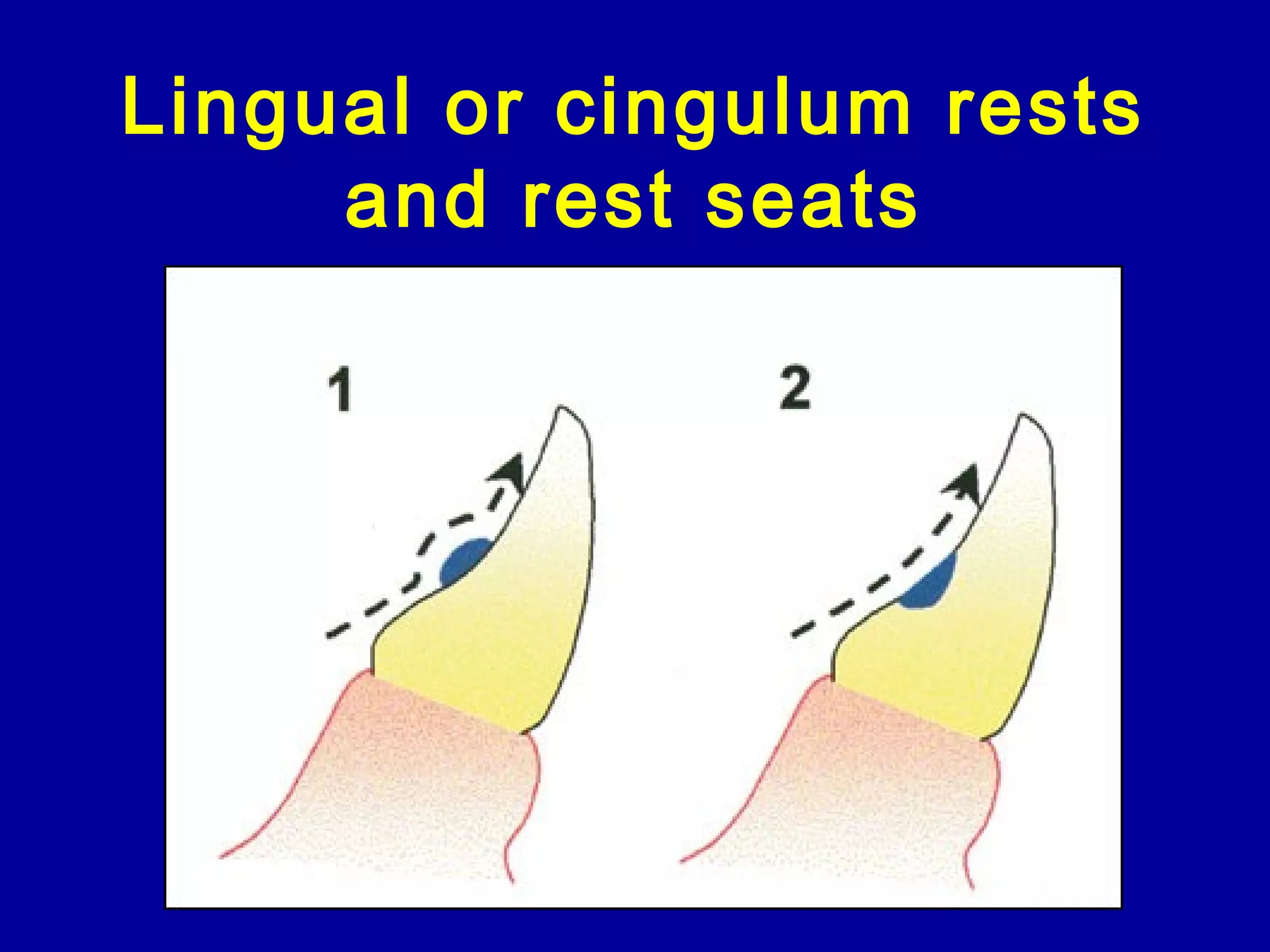 Lingual or cingulum rests
and rest seats
 