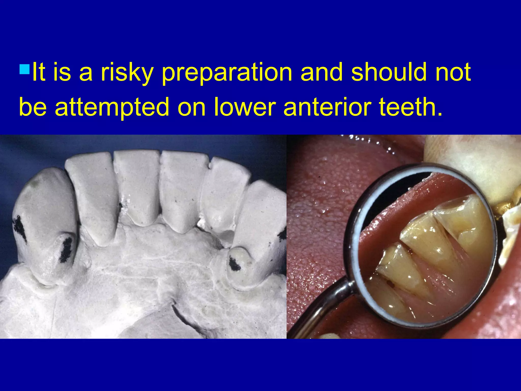 It is a risky preparation and should not
be attempted on lower anterior teeth.
 