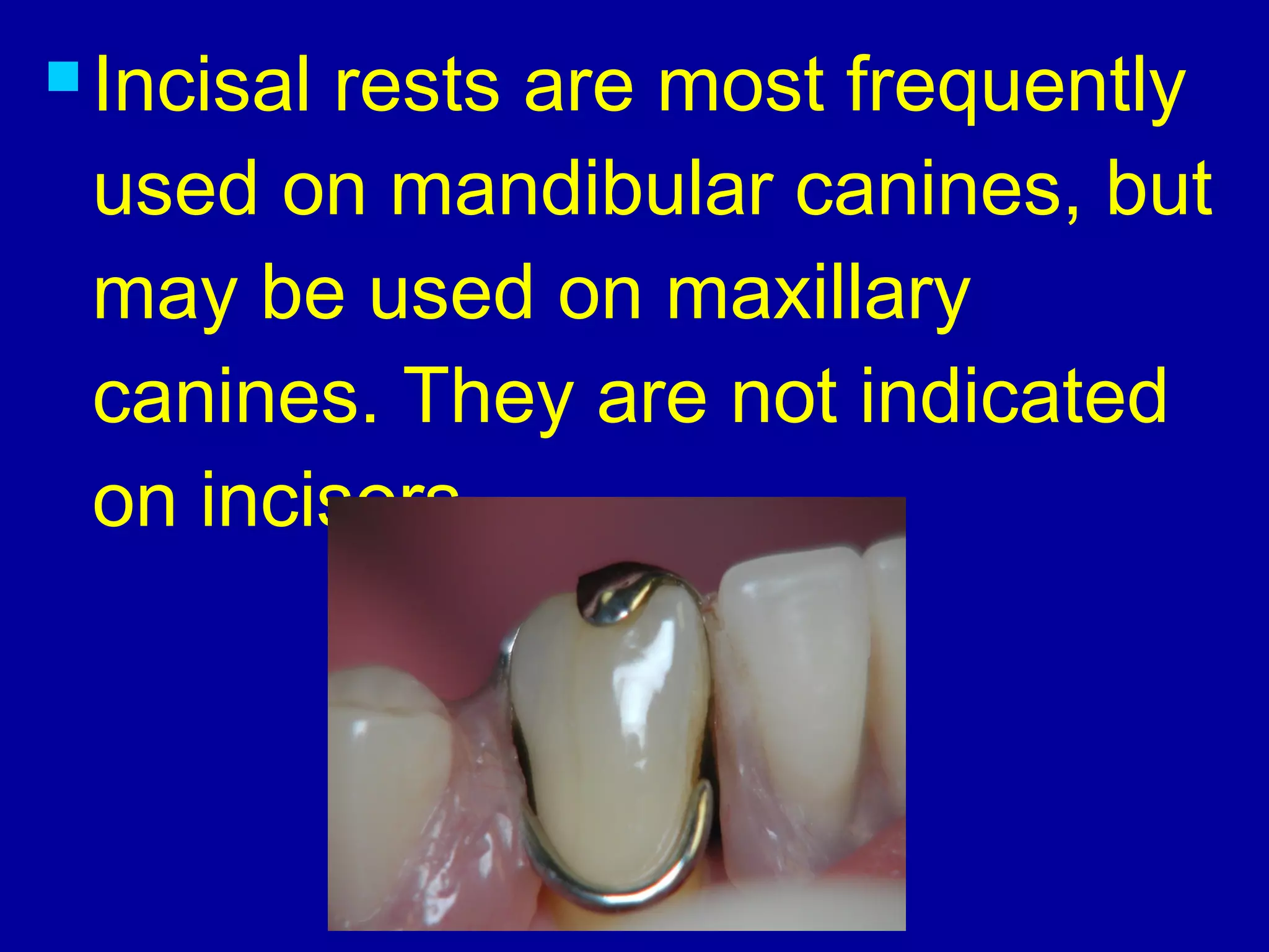  Incisal rests are most frequently
used on mandibular canines, but
may be used on maxillary
canines. They are not indicated
on incisors.
 